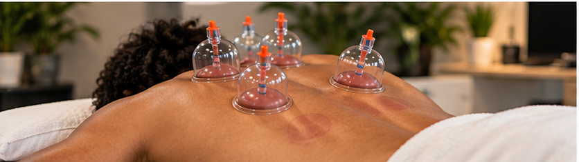 Cupping therapy